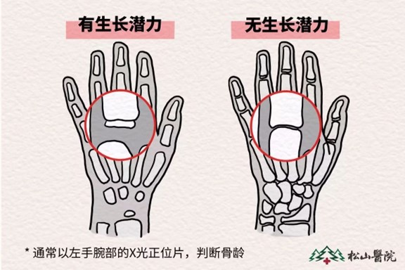 骨齡監(jiān)測(cè)。重慶松山醫(yī)院供圖