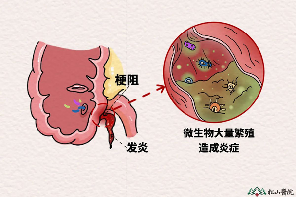 闌尾發炎示意圖。重慶松山醫院供圖