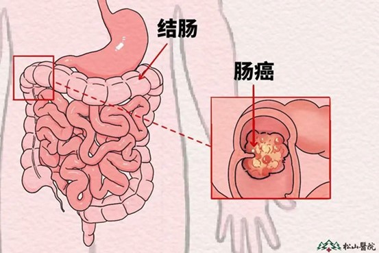 示意圖。重慶松山醫院供圖